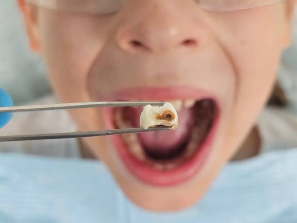 Best Emergency Treatment for Oral Infections in Pierre, SD